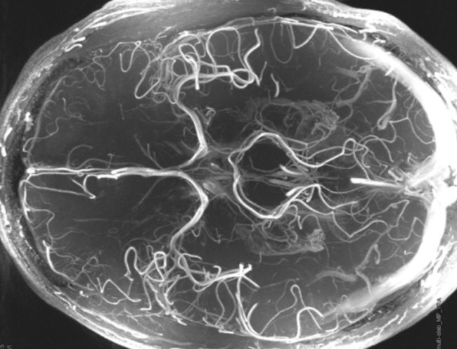 Cass Anderson Brain
