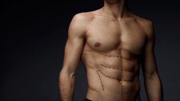 These Are The 5 Most Common Plastic Surgery Procedures For Men