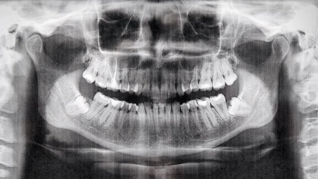 A 7-year-old boy in India had 526 teeth removed from his mouth in a surgery to correct his "compound composite ondontome."