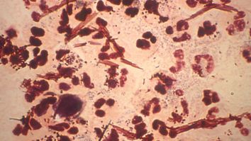 This Guy Went On Vacation And All He Got Was This Agonizing Strain Of Super Gonorrhea