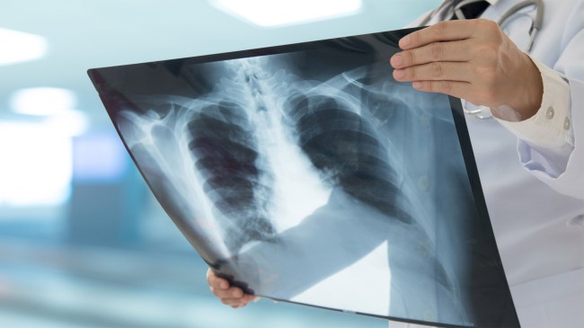 tuberculosis-lung-x-ray