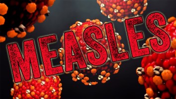 US Measles Cases Reach Highest Point In 33 Years, Over 5,000 Infected In Canada